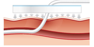 BIOPATCH antimicrobial wound dressing 2.5cm+4.0mm